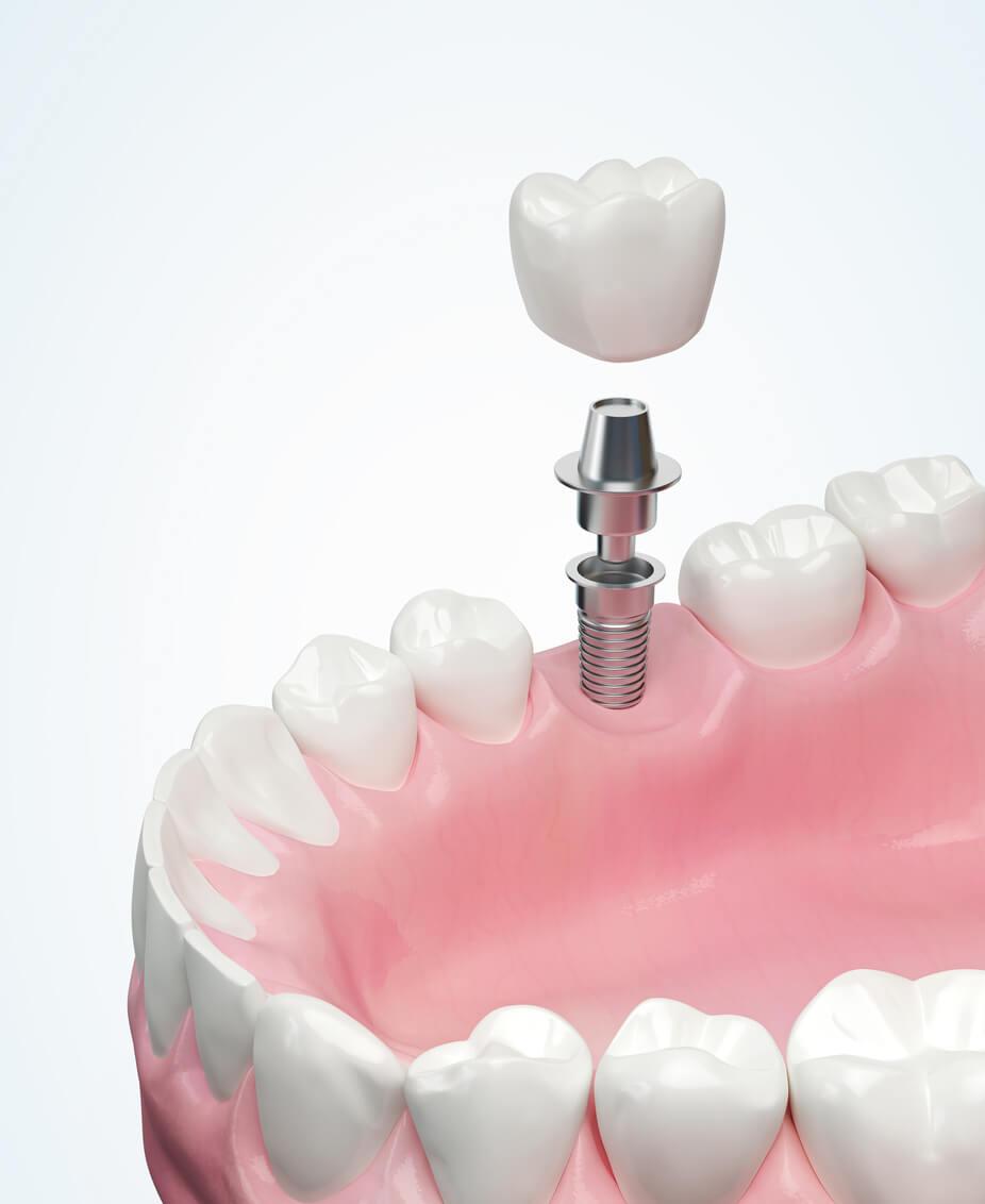 Single Tooth Implant