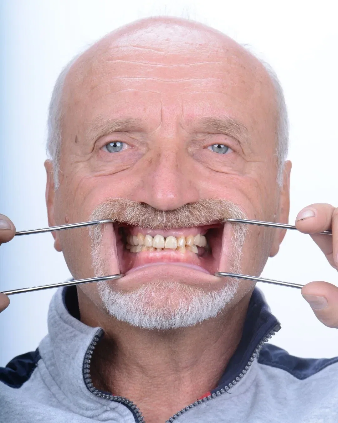 Before - Dental implant transformation - life-changing results