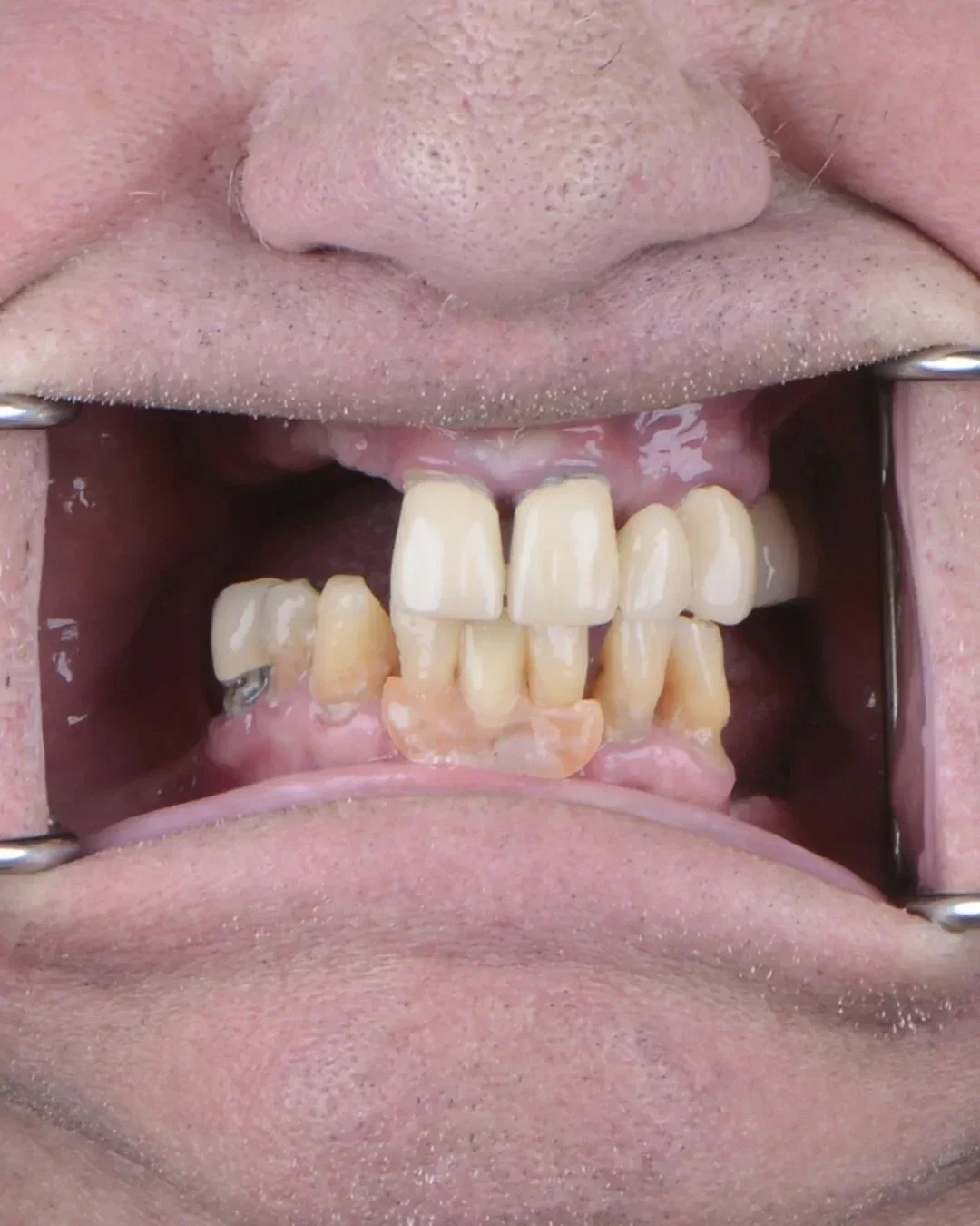 Before teeth close-up - Dental implant transformation - life-changing results