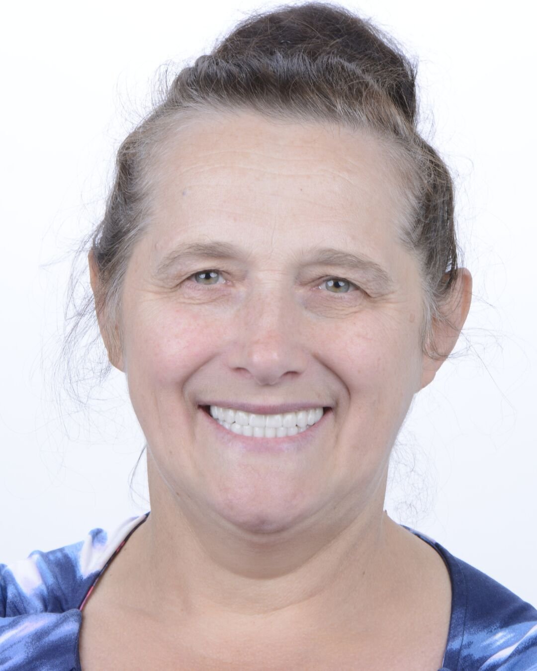 After - Dental implant transformation - beautiful new smile