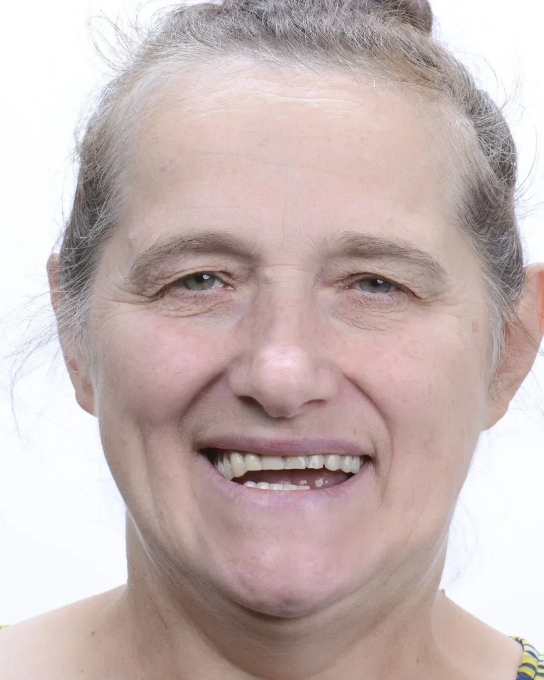 Before - Dental implant transformation - beautiful new smile