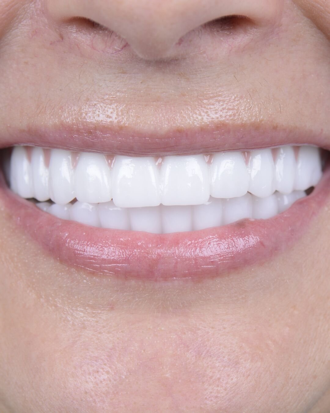 After teeth close-up - Dental implant transformation - beautiful new smile