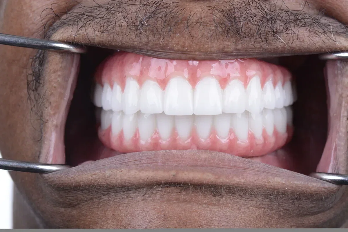 After teeth close-up - Dental implant transformation - full smile restoration
