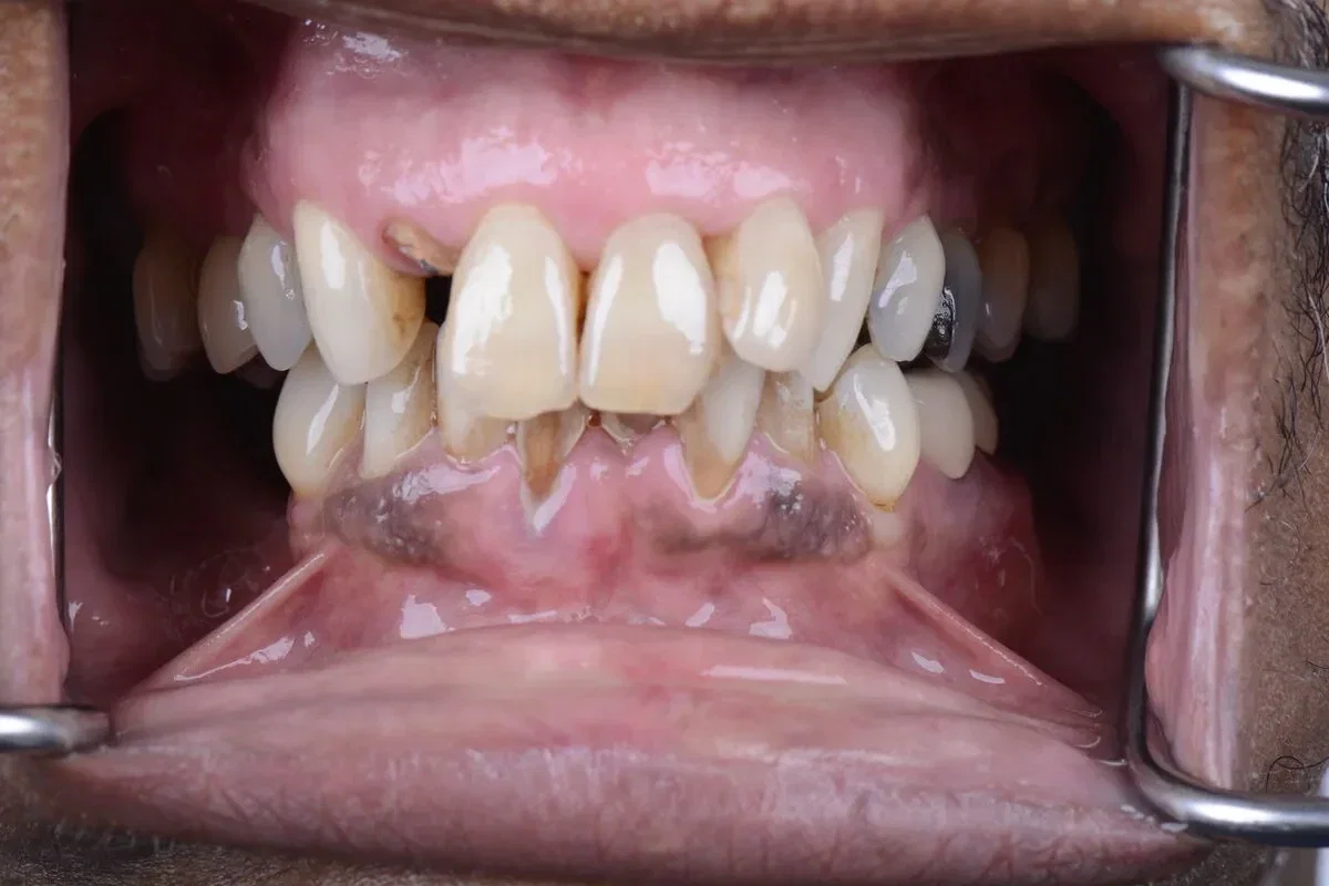 Before teeth close-up - Dental implant transformation - full smile restoration