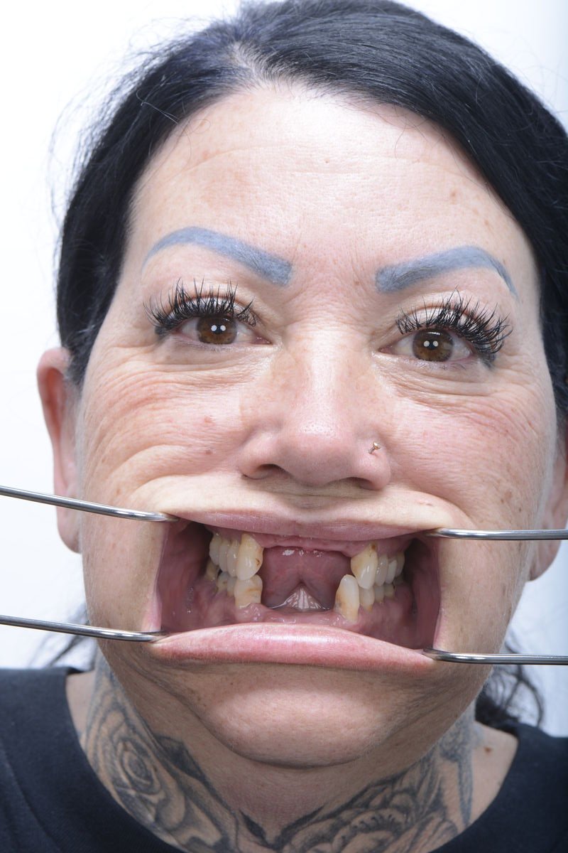 Before - Dental implant transformation - confident new smile