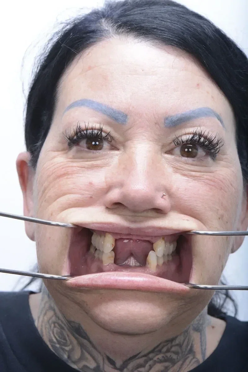 Before - Dental implant transformation - confident new smile