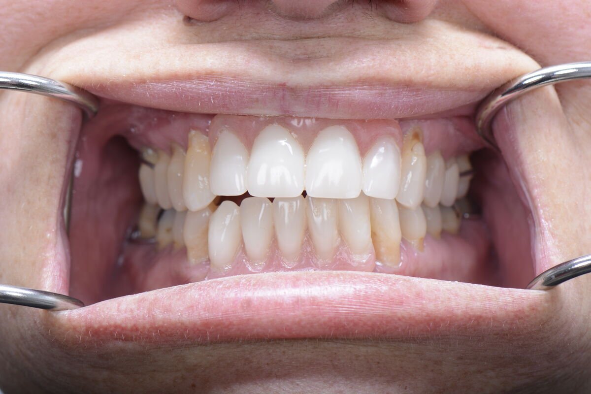 After teeth close-up - Dental implant transformation - confident new smile