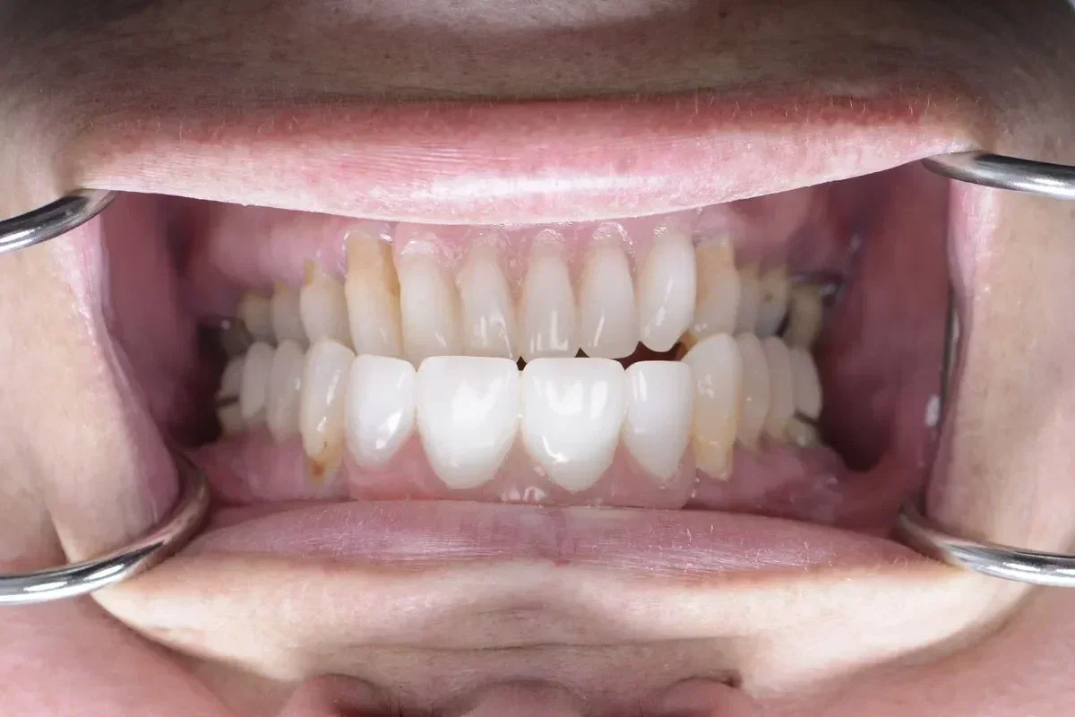 After teeth close-up - Dental implant transformation - confident new smile