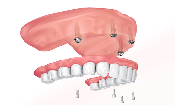 All-on-4 Fusion Dental Implants Roseville, California