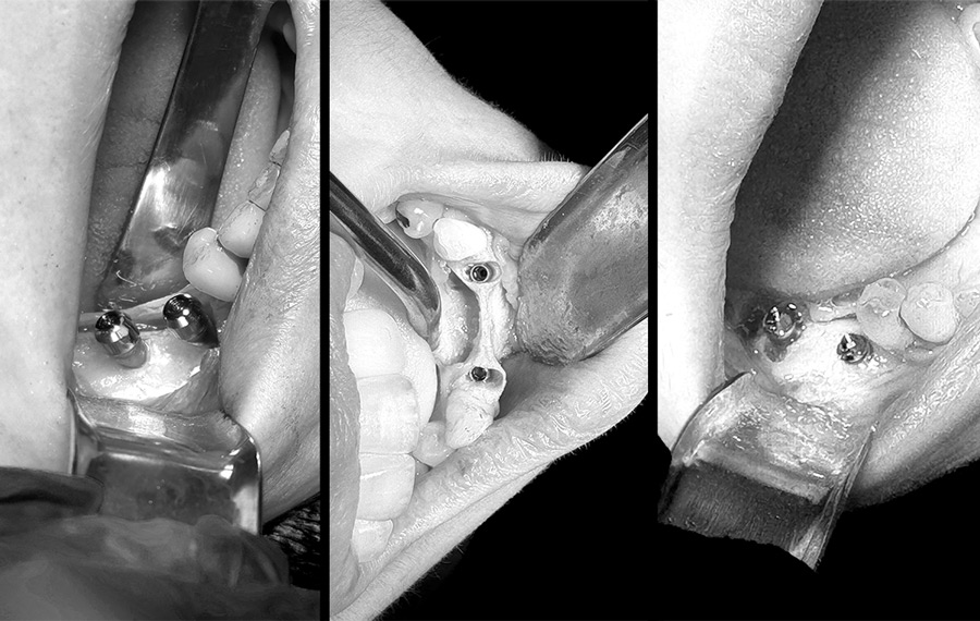 Restoring Teeth with Bone Atrophy: Solutions and Strategies from Fusion Dental Implants at Roseville, CA