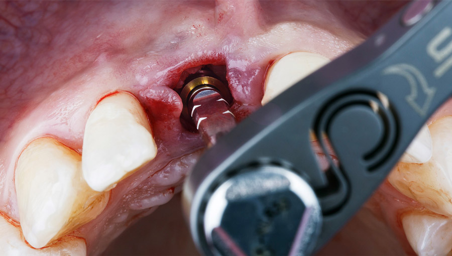 Immediate Loading Implants: Revolutionizing Dental Restorations with Fusion Dental Implants at Roseville, CA