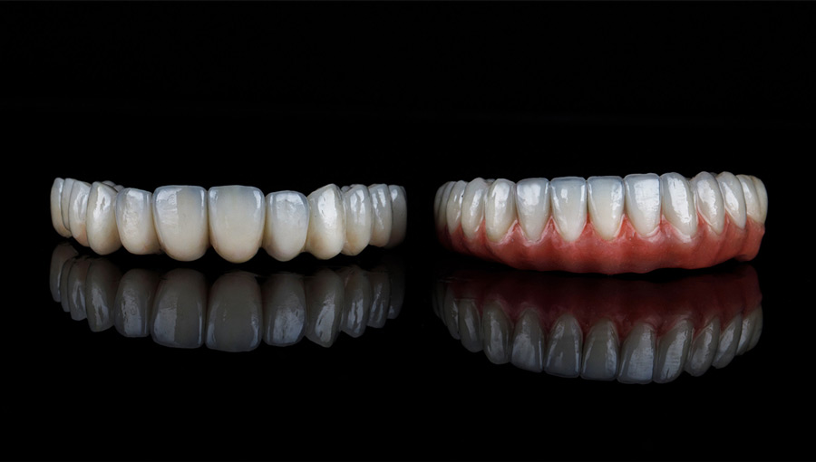 Replacing Removable Dentures with Permanent Teeth
