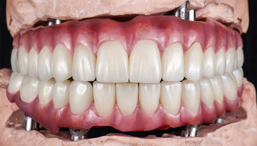 All-on-4 Implants: Restoring Your Entire Arch with Minimal Implants