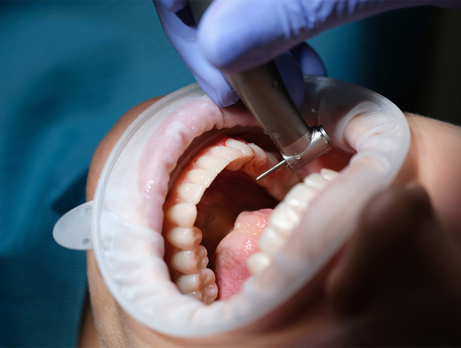 Debunking Common Myths About Dental Implants
