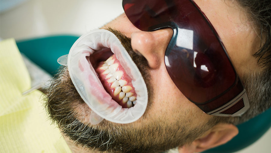 The Ultimate Step-by-Step Guide to All-on-4 Dental Implants: From Consultation to Your Perfect Smile