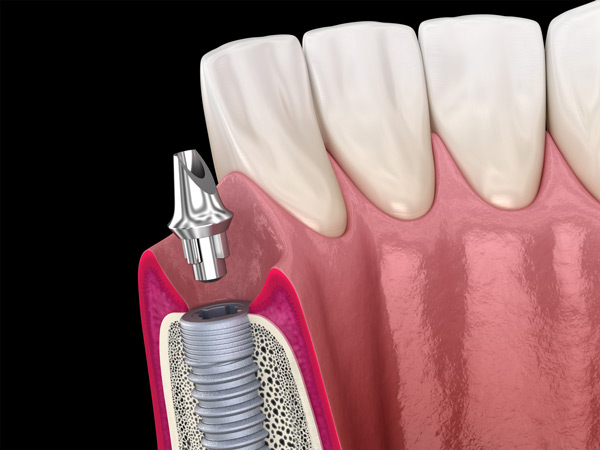 Dental Implants from consultation to a confident new smile