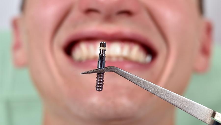 Is Getting Dental Implants Painful? What Real Patients Say About the Experience