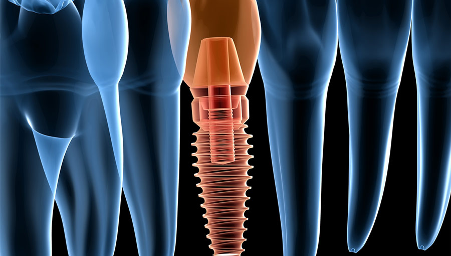How Soon Can You Get Dental Implants After a Tooth Extraction?