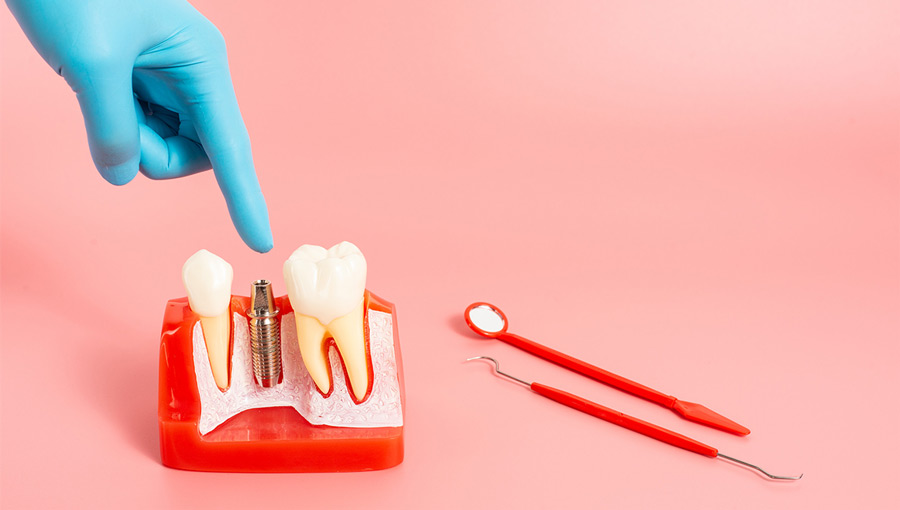 How Long Do Dental Implants Last—and How Can You Make Them Last Even Longer?