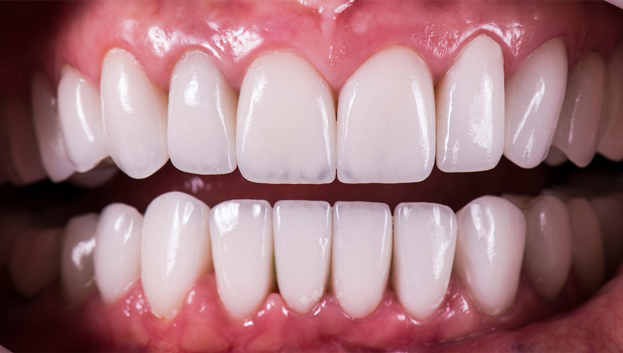 “Teeth in a Day”: Is Same-Day Dental Implant Treatment Too Good to Be True?