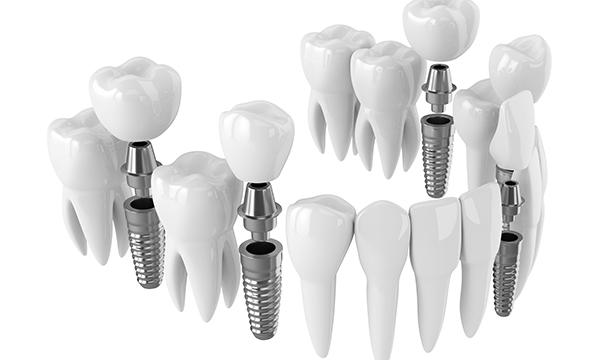 Single and Multiple Fusion Dental Implants Roseville, California