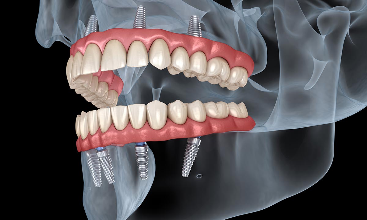 Final Teeth Delivered at Fusion Dental Implants Roseville, California