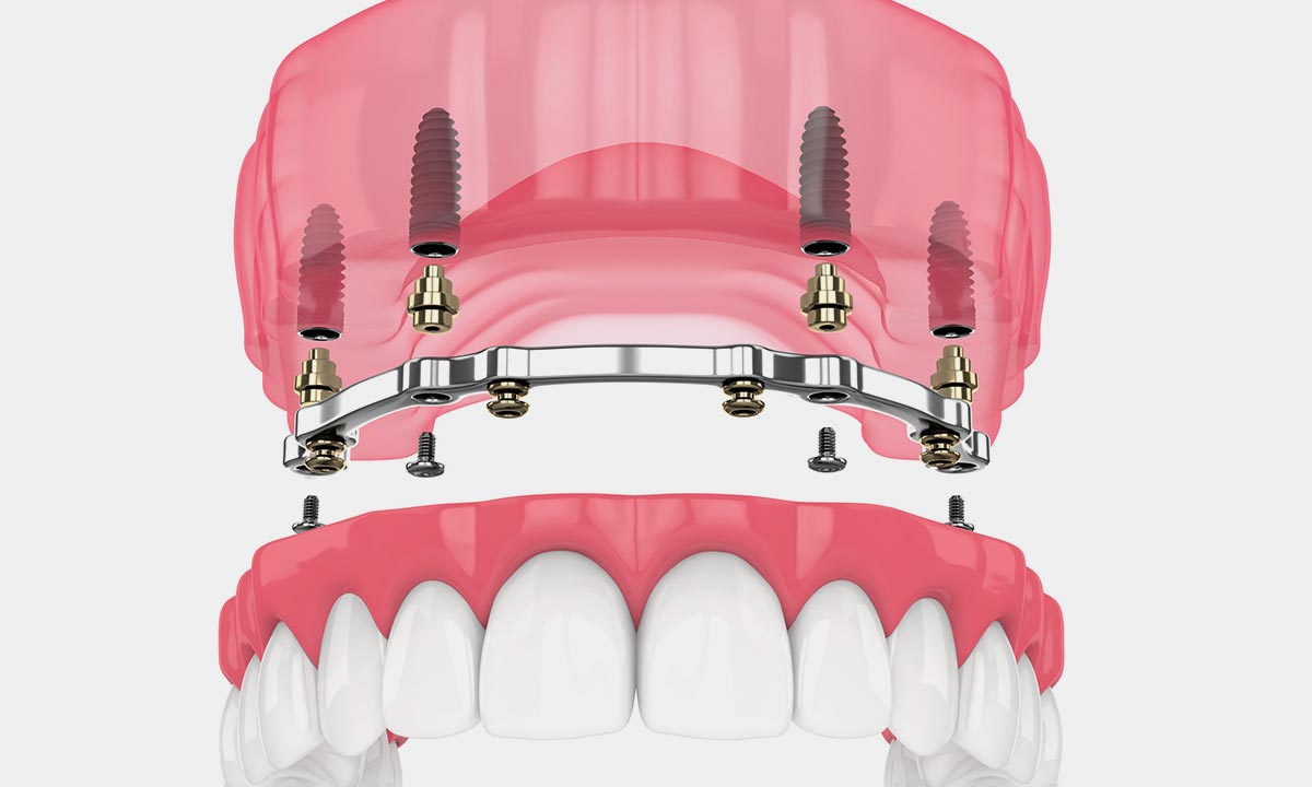 All-on-4 Fusion Dental Implants Roseville, California