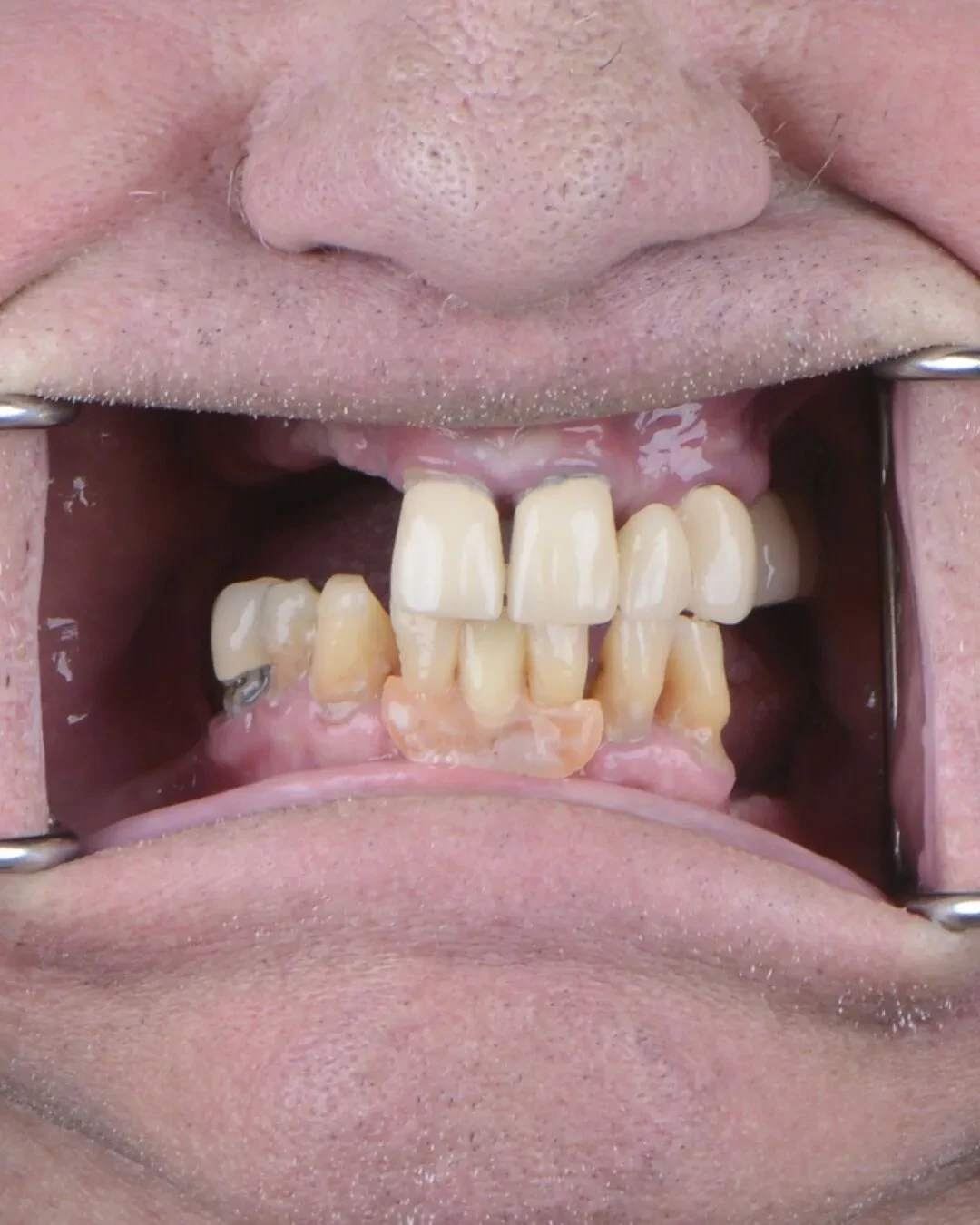 Before teeth close-up - Dental implant transformation - life-changing results