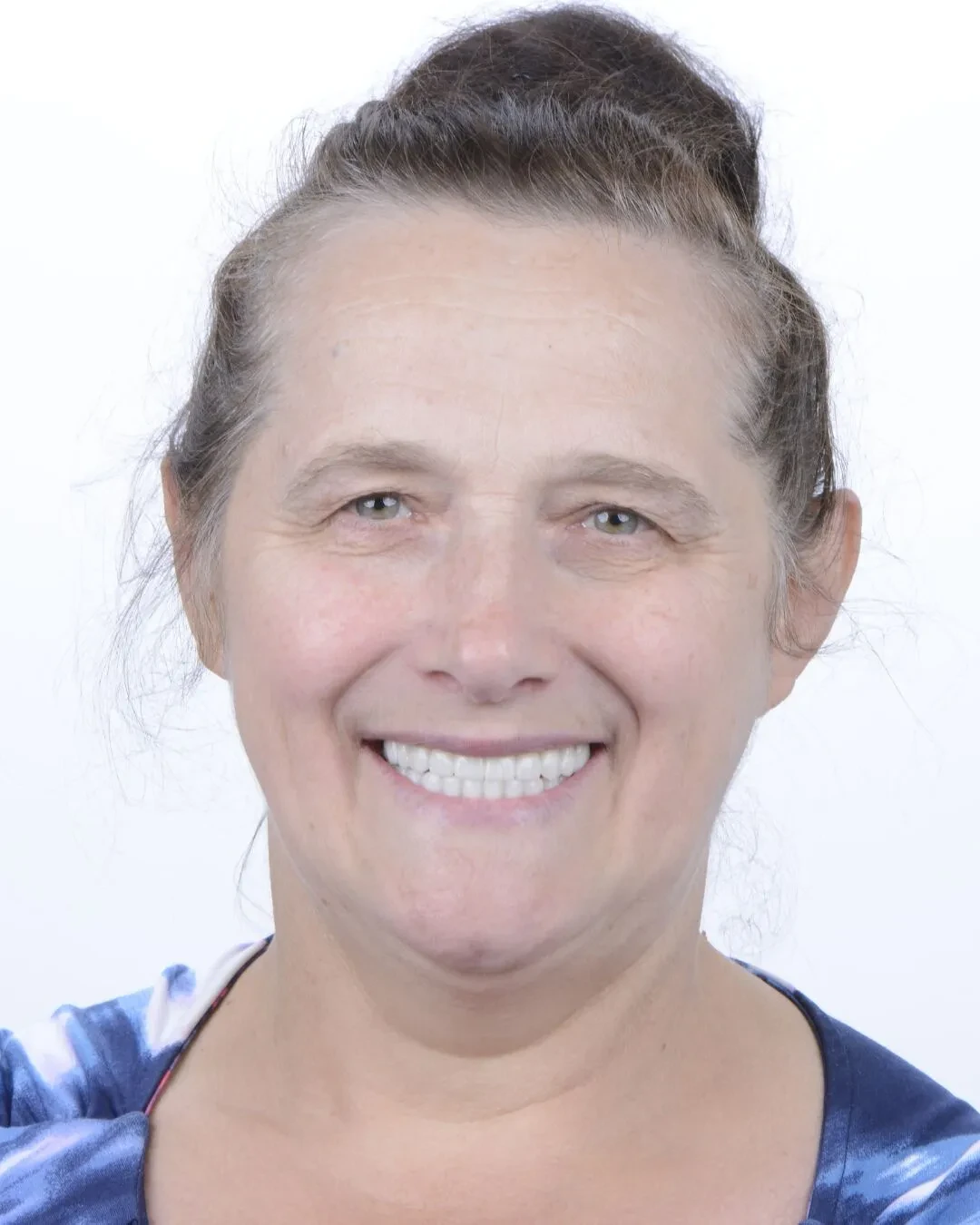 After - Dental implant transformation - beautiful new smile