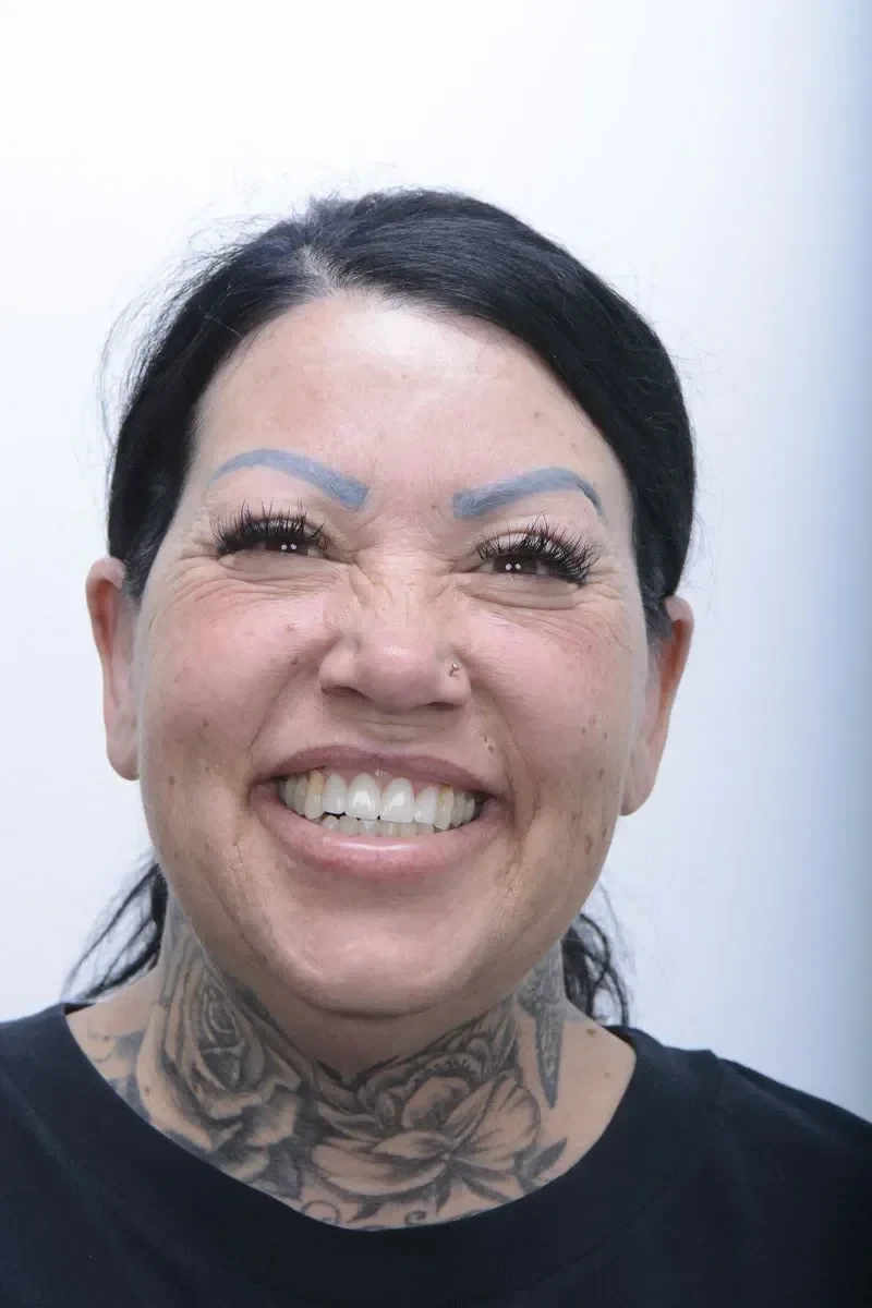 After - Dental implant transformation - confident new smile