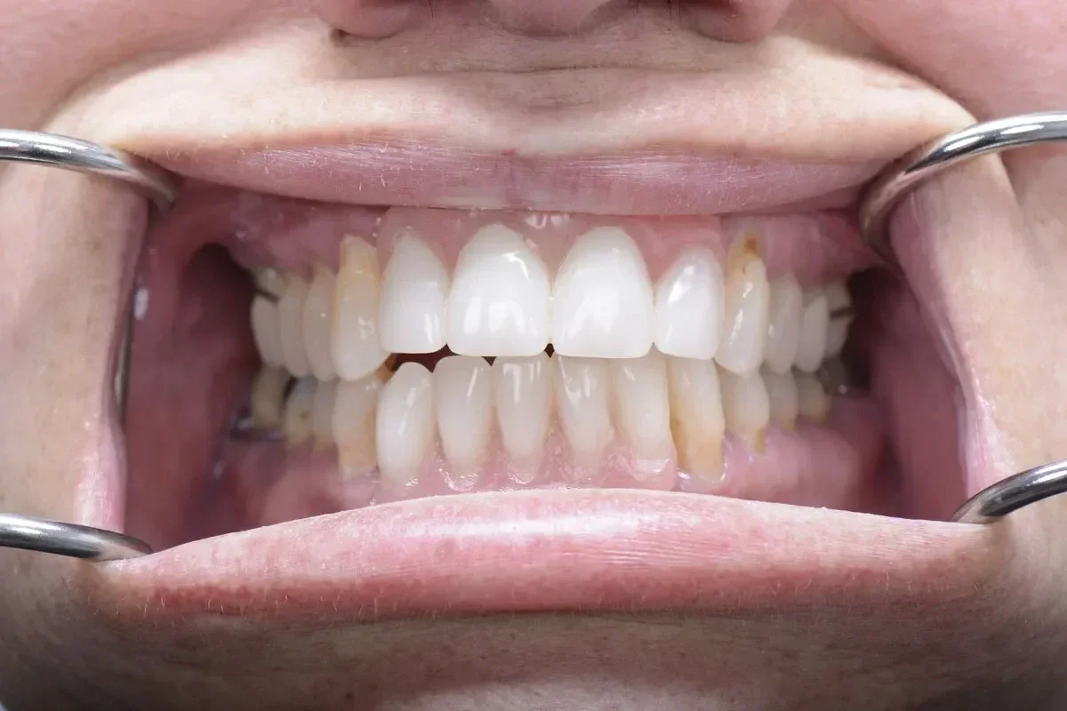 After teeth close-up - Dental implant transformation - confident new smile
