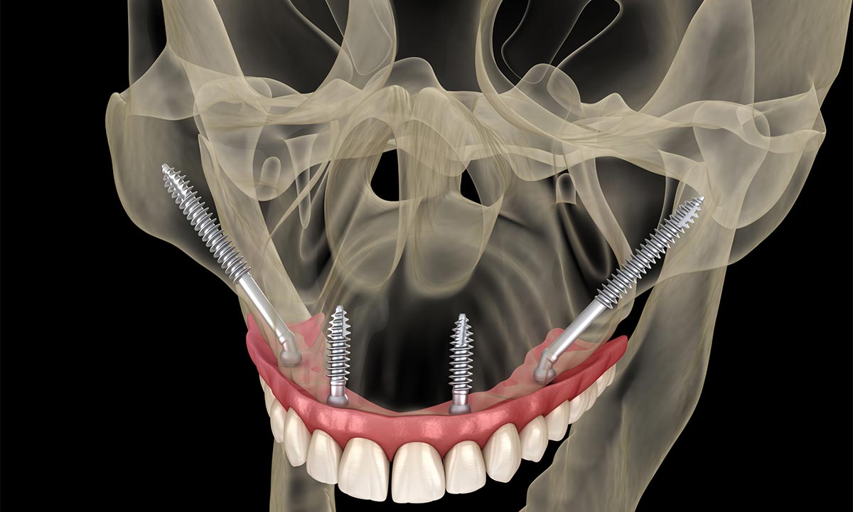 Single and Multiple Fusion Dental Implants Roseville, California
